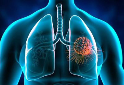 Phụ nữ có tỷ lệ mắc ung thư phổi cao hơn nam giới - Thực hư ra sao?